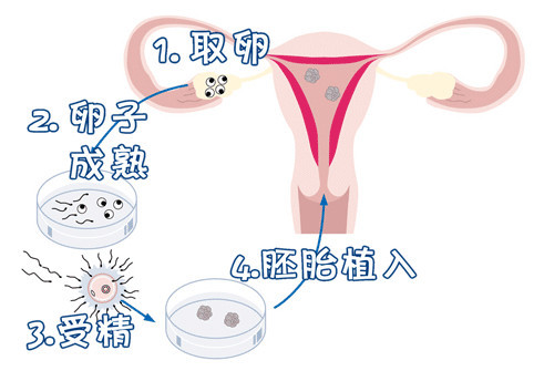 找卵代生子机构